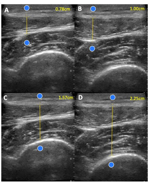 figure-results-5 Ultrasound measurements diagram, showing depth changes, labeled A-D, with distances in centimeters.