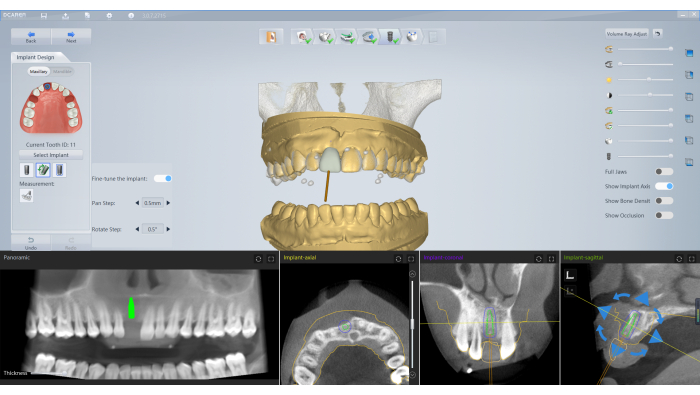 Dental implant planning, digital model, and imaging analysis for tooth restoration evaluation.