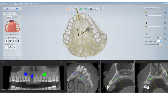 Dental implant planning diagram showing 3D jaw model, CT scan analysis, implant position.