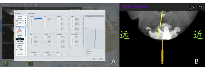 Dental CAD software interface and coronal drill diagram for implant planning and placement.