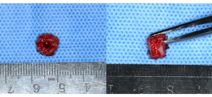 Biopsy sample measurement with ruler and tweezers on blue surgical drape; tissue analysis preparation.