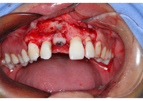 Dental implant surgery, open gum tissue, showing implant site and surrounding teeth, oral health.