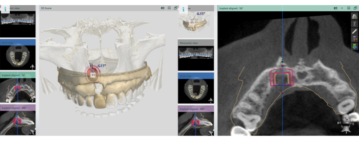 3D jaw scan visualization, implant planning diagram, CT image analysis for dental implant alignment.