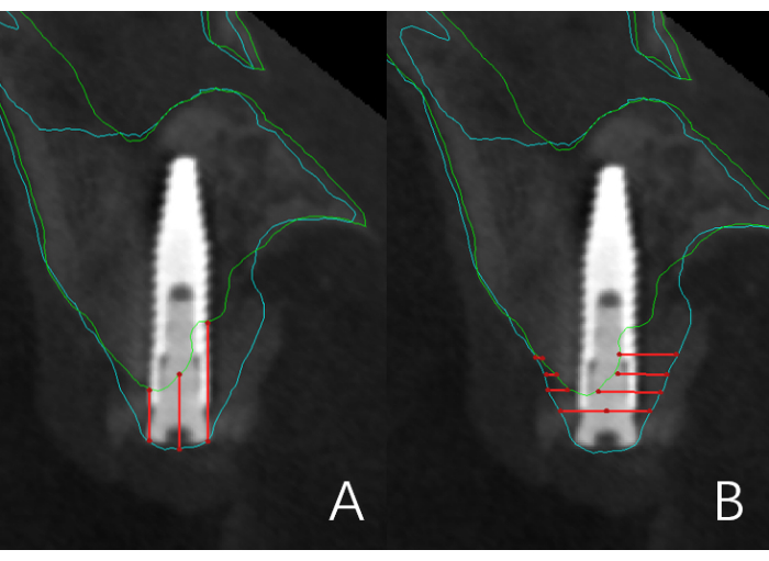 Dental CBCT analysis of implant post stability; diagram showing measurements and contours.