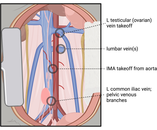 figure-protocol-4 Abdominal vascular anatomy diagram, labeled veins branching from aorta and iliac vein.