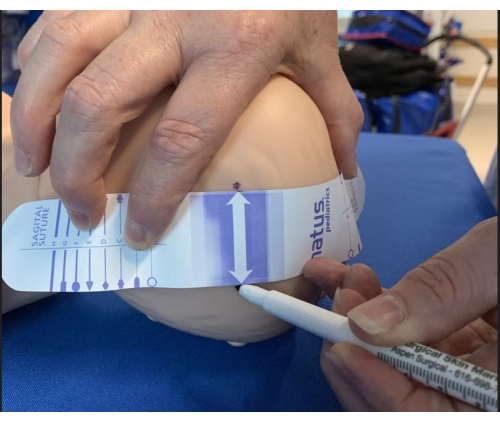 figure-results-2 Newborn head circumference measurement using tape for neonatal growth assessment.