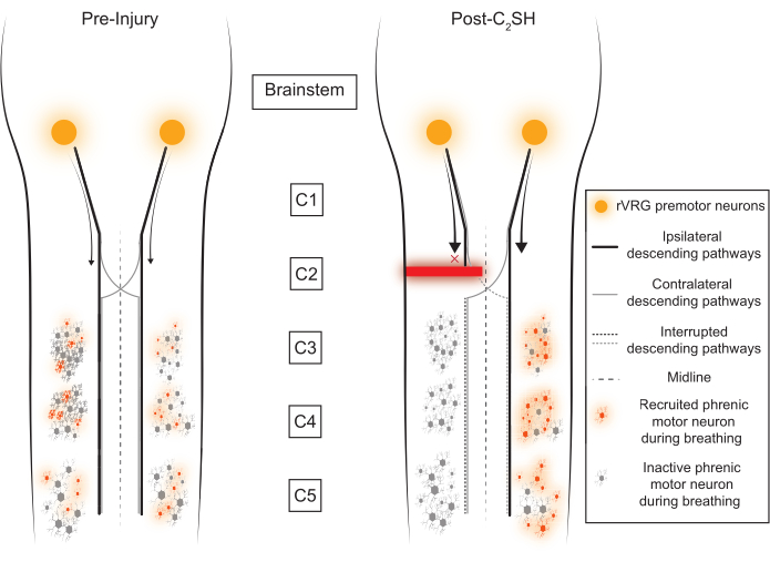 Pre- and post-injury spinal cord pathways diagram; neuron pathways, recruitment, and interruption.