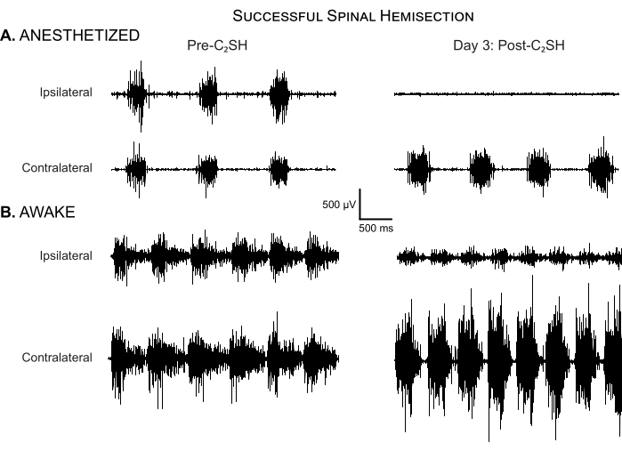 Spinal hemisection waveform results, anesthetized vs. awake, pre- and post-procedure comparison.