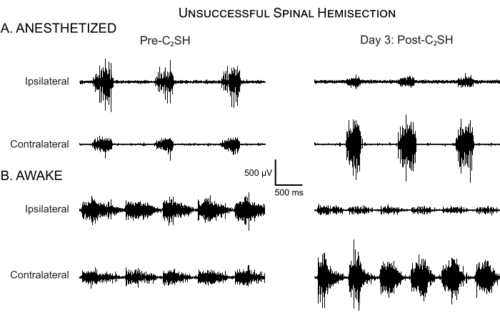 EEG waveforms of anesthetized and awake states showing effects of unsuccessful spinal hemisection.