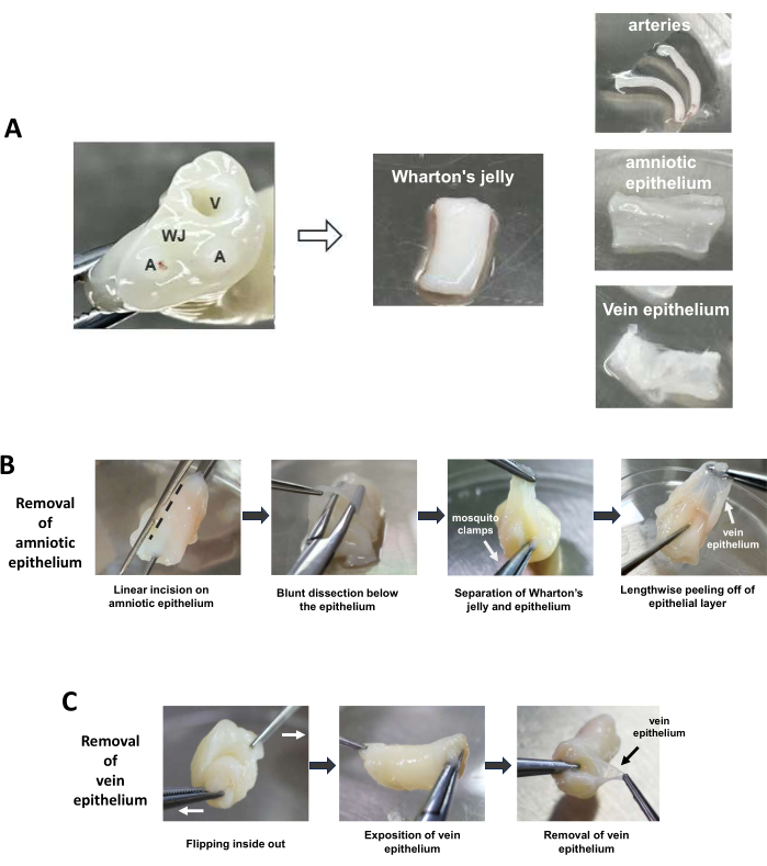 Dissection diagram of Wharton's jelly, vein separation, and amniotic epithelium removal steps.