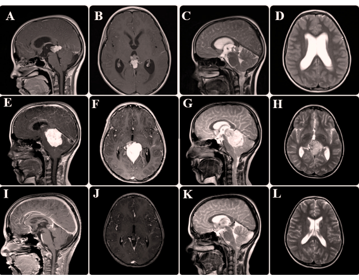 Griglia di scansione cerebrale MRI che mostra la progressione del tumore nelle viste sagittale e assiale, studio di imaging medico.