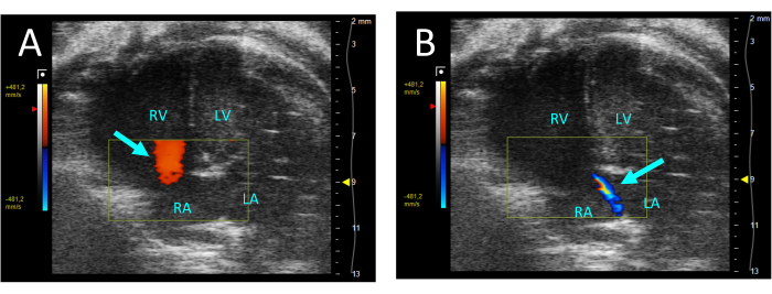 Cardiac ultrasound diagram showing blood flow velocity, right atrium, left atrium, Doppler analysis.