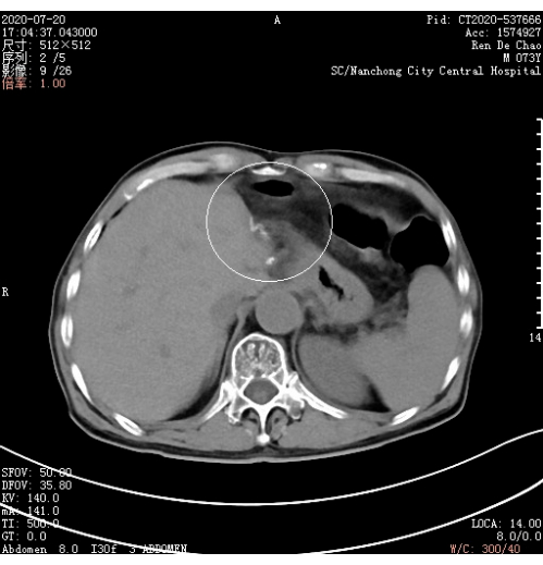 CT scan showing abdominal cross-section; medical imaging analysis; diagnostic radiology.