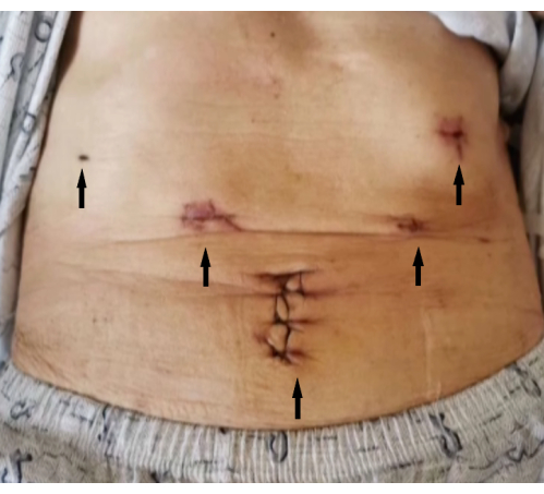 Post-surgery abdominal incision marks; laparoscopic procedure; patient recovery analysis.