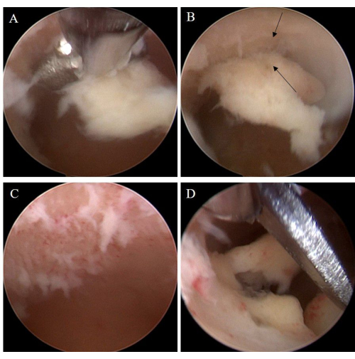 figure-results-2 Arthroscopic knee surgery procedure with instruments, cartilage repair method; clinical study images.
