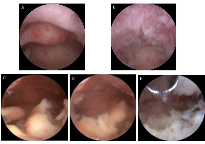 figure-results-3 Arthroscopy procedure series; joint inspection; cartilage condition assessment; medical imaging.