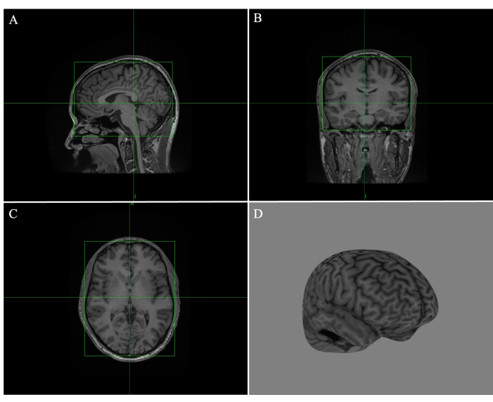 MRI brain scan views: sagittal, coronal, axial planes; 3D brain model for neuroimaging study.