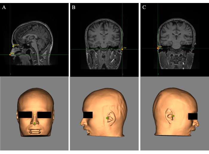 MRI imaging diagram; sagittal, coronal views; cranial anatomy analysis; 3D head rendering.