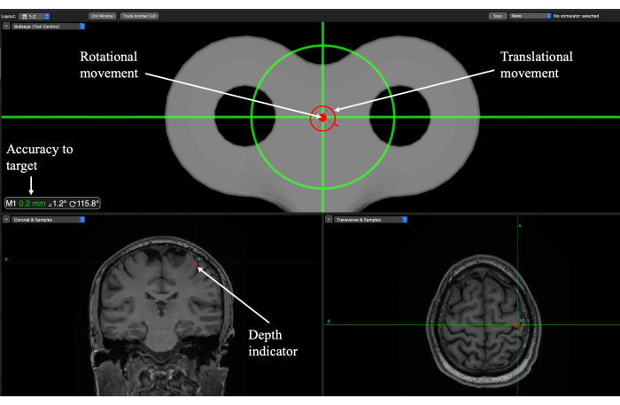 MRI-guided brain targeting diagram; rotational, translational movement; accuracy, depth indicator.