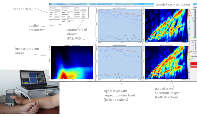 patient data analysis using signal processing; diagram and equipment for guided wave spectrum study