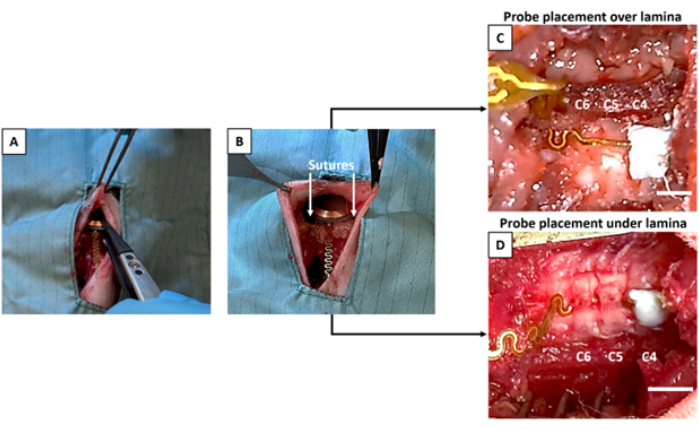 figure-results-3 Surgical probe placement diagrams showing suture technique and positions over and under lamina.