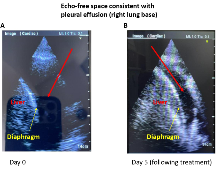 Ultrasound comparison of pleural effusion, liver, diaphragm; Day 0 vs. Day 5; cardiac imaging.