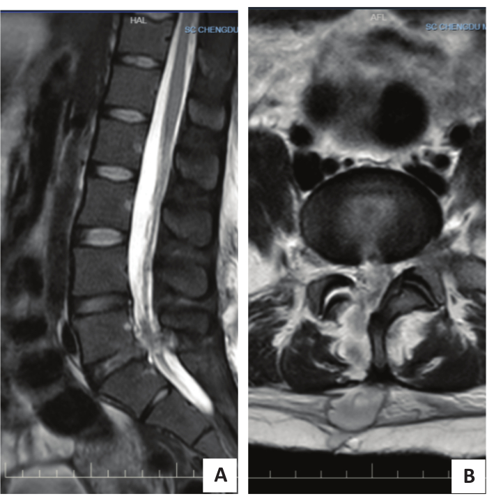 MRI scan showing spinal column; axial and sagittal views used for diagnostic imaging analysis.