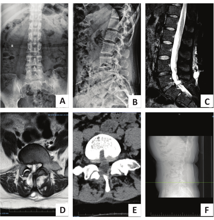 Spinal imaging, X-ray and MRI scans; lateral lumbar, sagittal views; radiology study results.