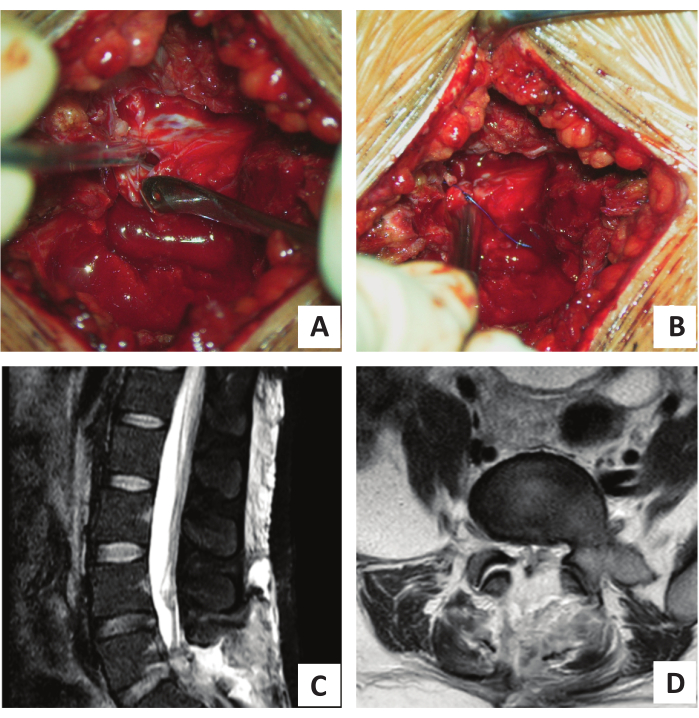 Surgical spinal operation, MRI imaging showing lumbar spine; medical procedure and diagnostic analysis.