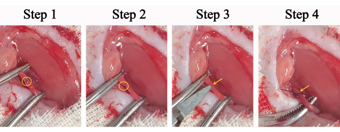 Surgical suture procedure, step-by-step, demonstrating incision repair with forceps and needle.