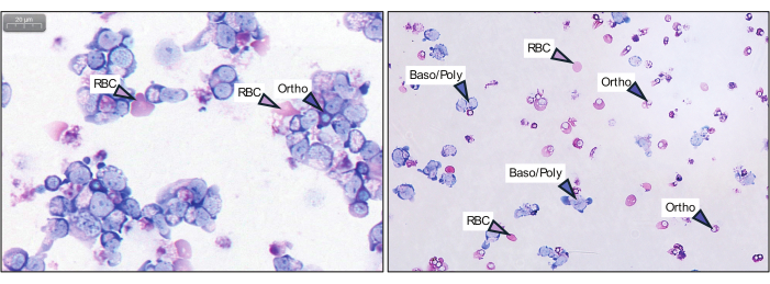 Blood cell analysis, microscope image showing RBCs, Baso/Poly, and Ortho differentiation.