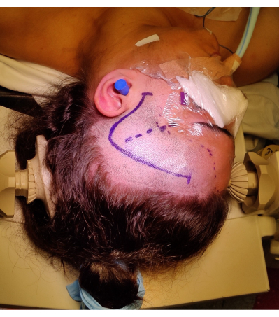 Surgical planning for cranial procedure; head marked with incision lines; medical setup.