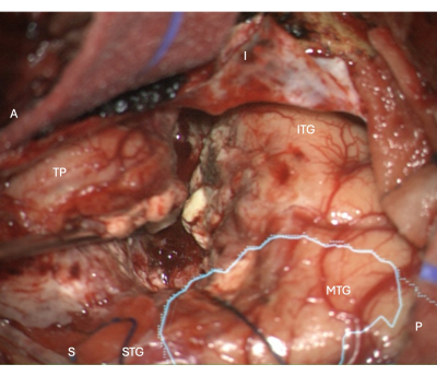Brain anatomy; labeled regions; middle temporal gyrus (MTG), inferior temporal gyrus (ITG).