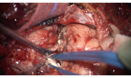 Surgical procedure showing brain anatomy for tumor excision; instruments and labeled regions visible.