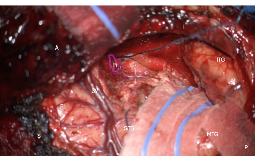 Surgical anatomy, labeled human brain dissection diagram, highlighting regions for educational purpose.