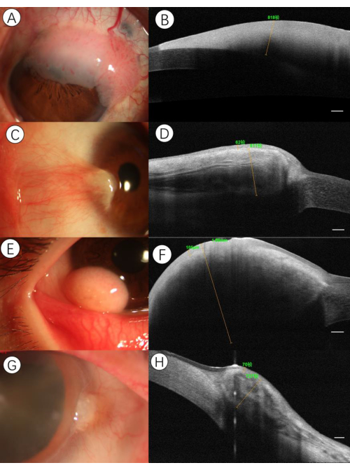 Ocular examination, anterior segment, OCT imaging, corneal assessment, eye health diagnostics.