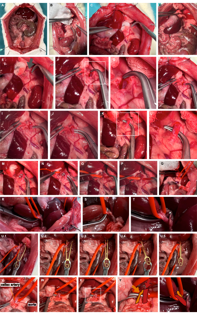 Surgical procedure series on porcine liver transplantation, showing vascular anastomosis and organ placement.