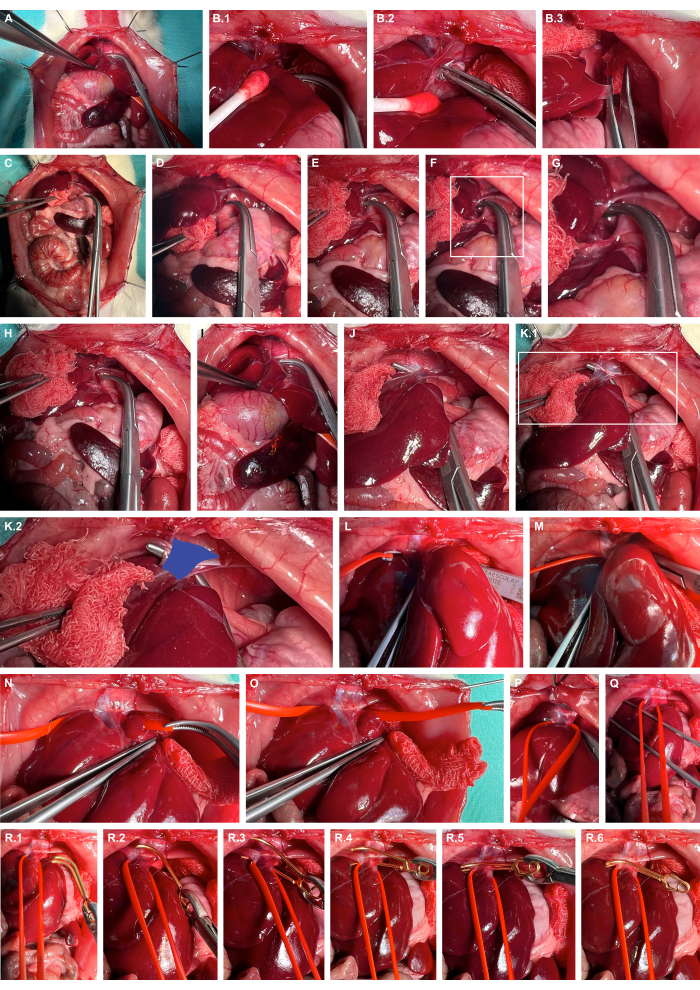 Surgical procedure on organ with clamps; detailed sequence of medical steps; operational setup.