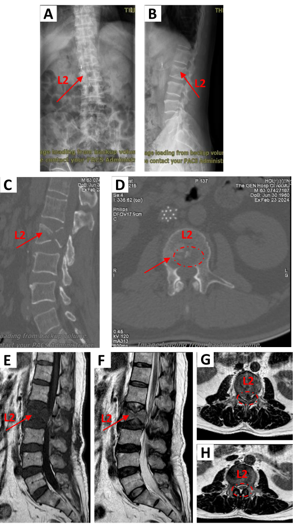 figure-results-2 Spinal imaging with X-ray, CT, MRI showing L2 vertebra; diagnosis, fracture identification.