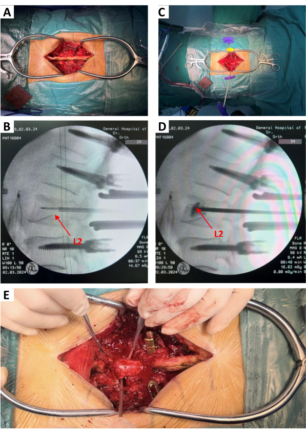 figure-results-4 Surgical spinal procedure steps with L2 reference; includes X-ray imaging and incision views.