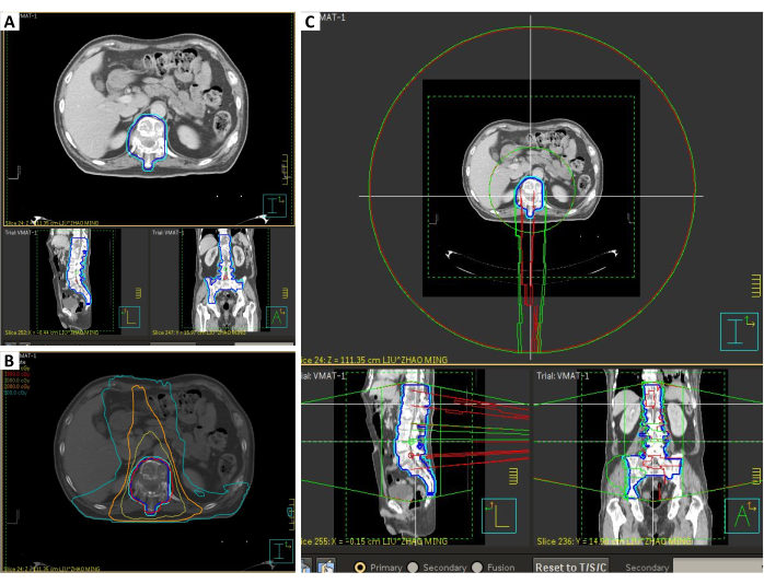 figure-results-5 CT scan diagrams of radiotherapy planning, showcasing tumor targeting and dose distribution analysis.