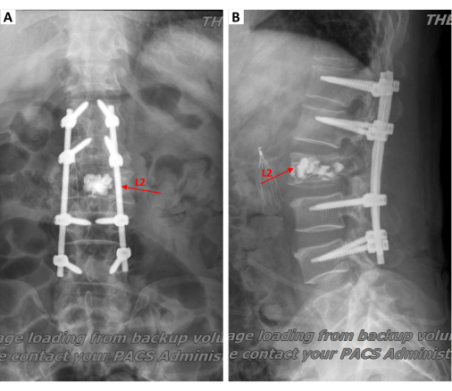 figure-results-6 Spinal surgery X-ray with L2 vertebrae fixation; medical imaging for post-operative assessment.