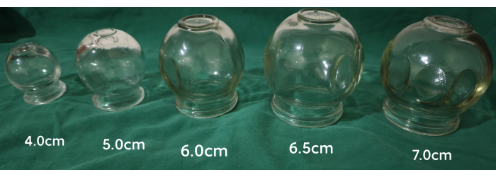 Cupping therapy glass cups of varying sizes; therapeutic equipment arrangement.