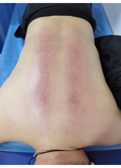 Therapeutic cupping effects on skin; reddened areas on back; alternative medicine method.