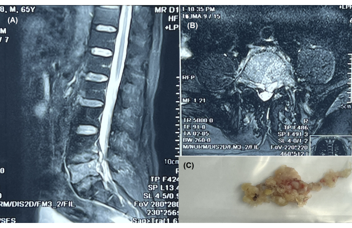 figure-results-1 MRI scan of spine, axial and sagittal views, with biopsy tissue sample for diagnostic analysis.