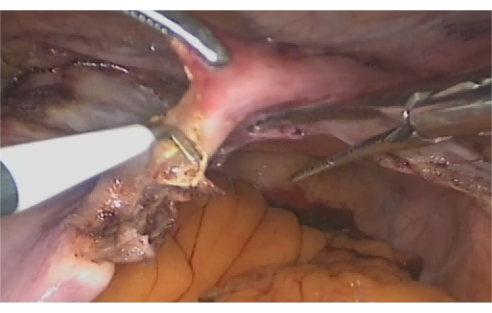Surgical technique, laparoscopic procedure, tissue dissection, endoscopic tools, medical operation.