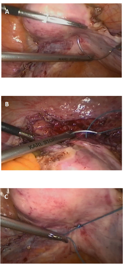 Laparoscopic suturing technique diagram; surgical tools securing tissue; minimally invasive surgery.