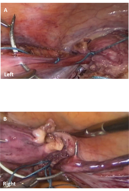 Medical procedure, suturing technique; two images showing different stages, left and right views.