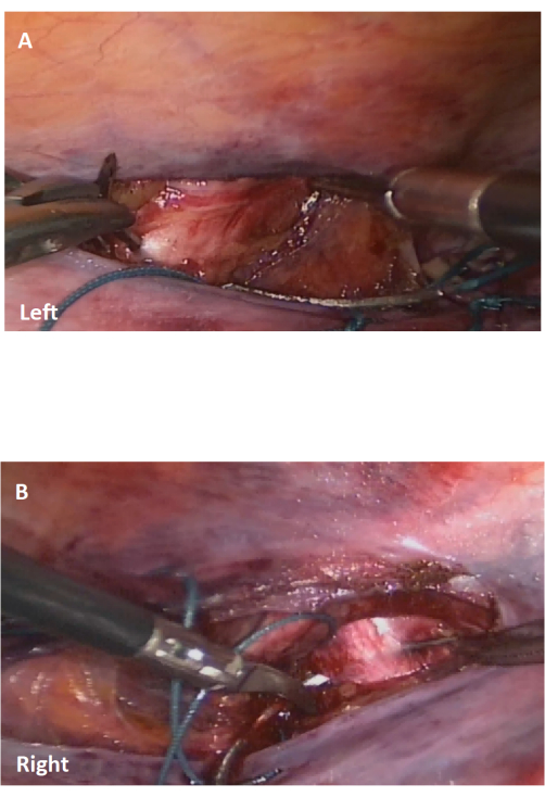Surgical procedure on tissue using endoscopic tools; two stages shown, left and right incision.