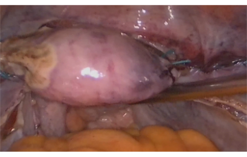 Ovarian dissection process, surgical procedure, image illustrating organ removal technique.